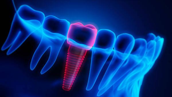 High-Quality Dental Implants in Fort Worth for a Natural Look