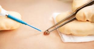 Mole Removal Results Timeline Explained